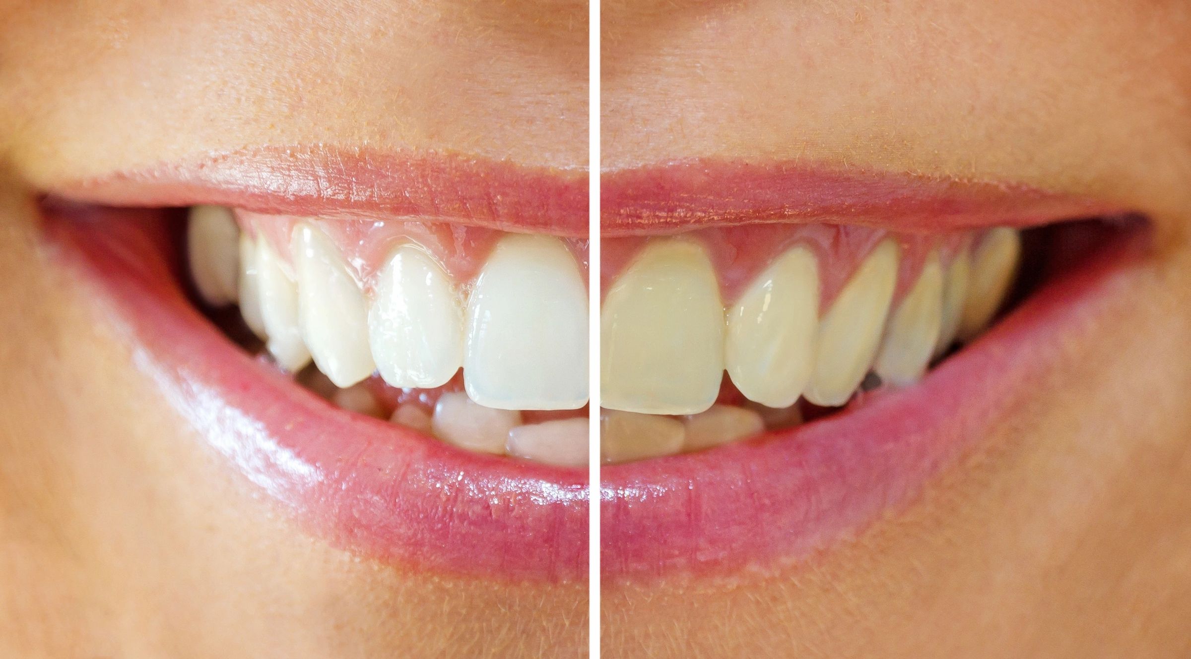 Whitening